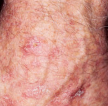 Actinic keratosis on head