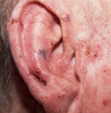 Actinic keratosis ear