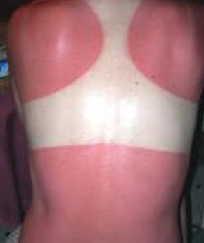 Tanning bed burns
