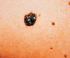 melanoma-moles