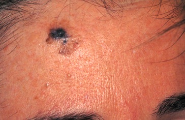 melanoma-on-forehead