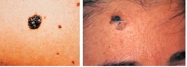 melanomas