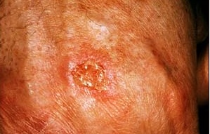 squamous-cell-carcinoma