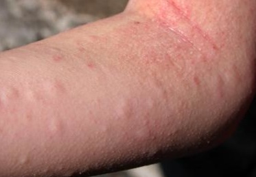 Sunscreen allergy