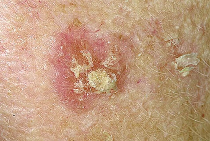 Actinic keratosis