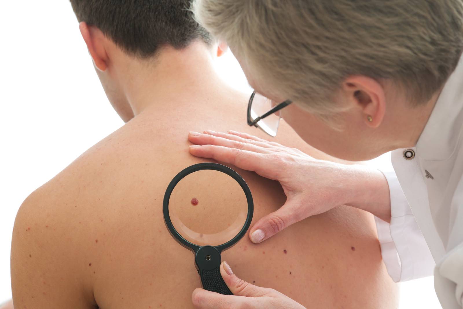 skin cancer checkup