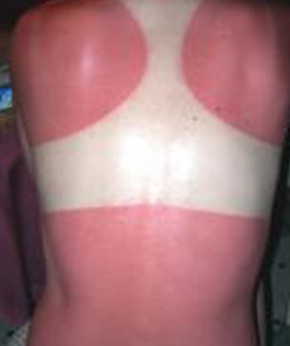 sun burn on back