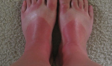 sun burn on feet