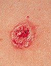 squamous2