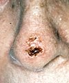 squamous3
