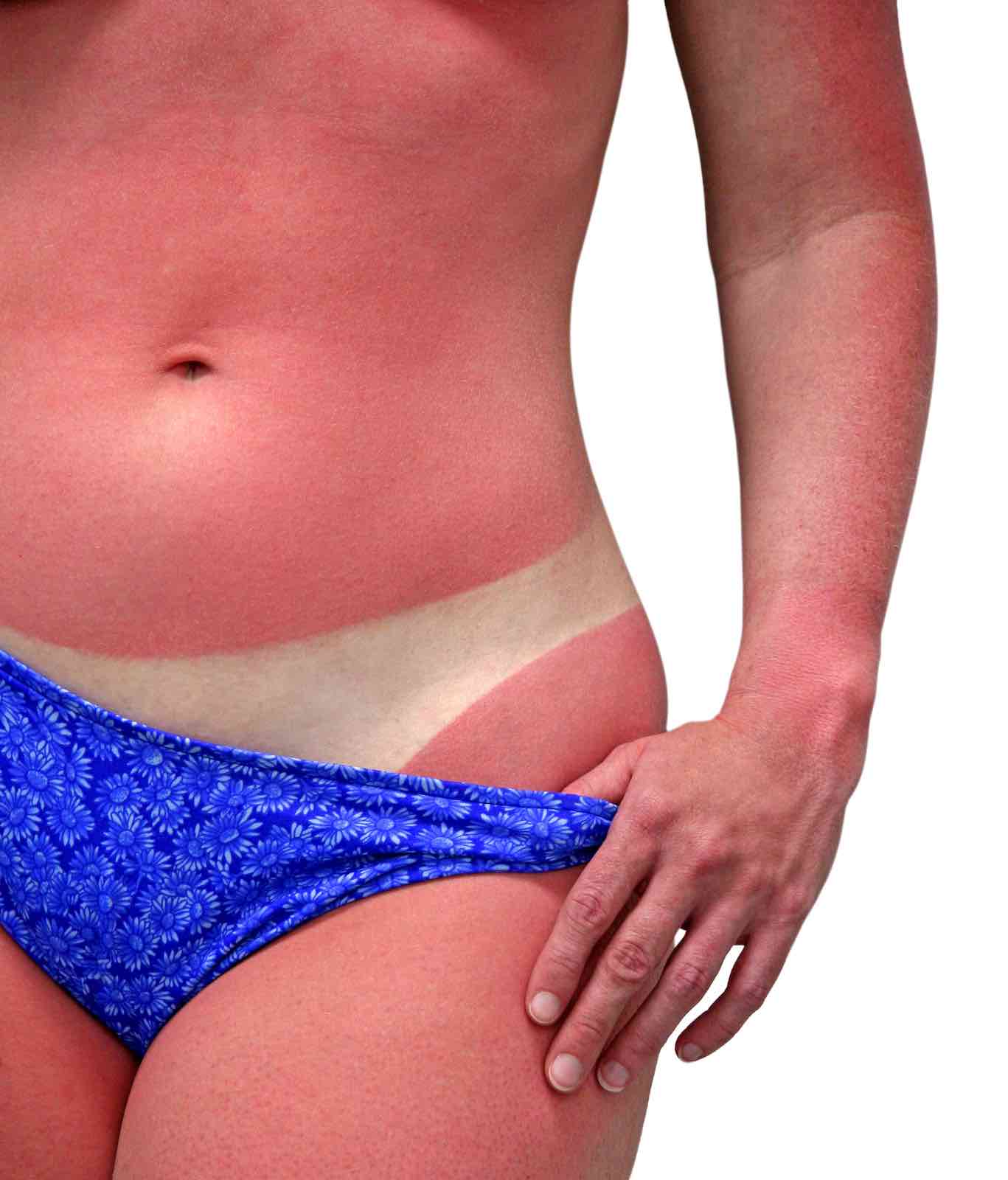 sunburn is a safety issue